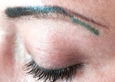 Korrektur nach misslungenen Laser-Behandlungen