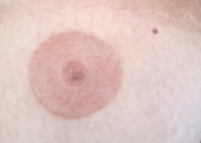 Mamillen Permanent Make-up nach Brust-OP