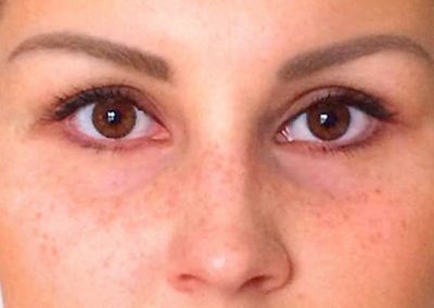 Korrektur eines misslungenen Brauen-Microbladings